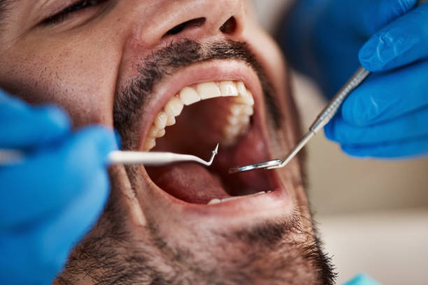 Best Emergency Dental Care for Broken or Chipped Teeth in Frent Hills, MO